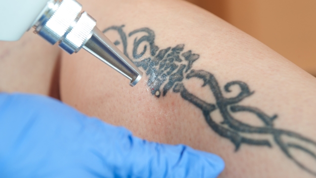 Home Tattoo Removal – Does It Work?