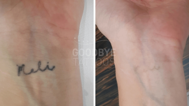 Tattoo Removal Cream – What Through Using Know?