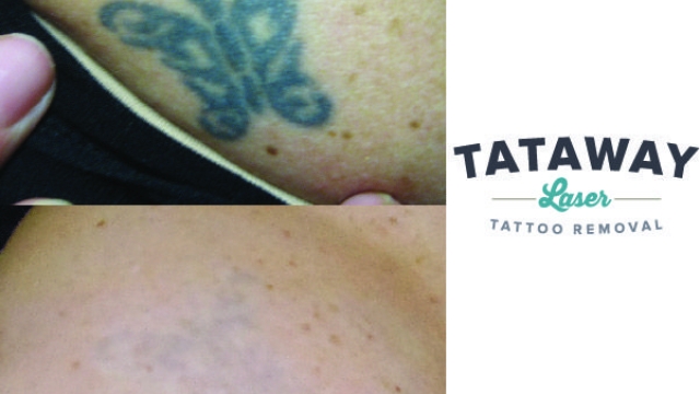 The Associated With Tattoo Removal: Read This And Avoid Money